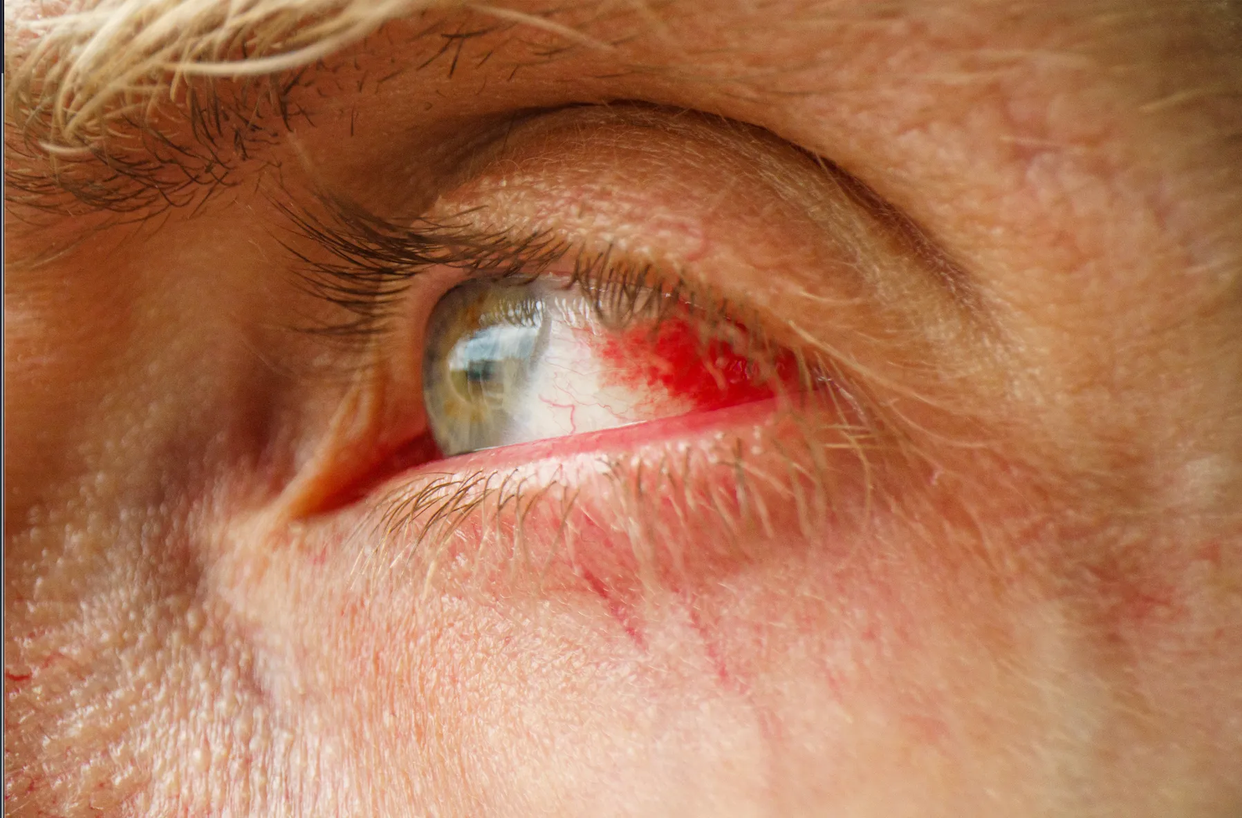 Eye conditions that are sensitive to the light should refrain from using RLT as it causes further damage. 