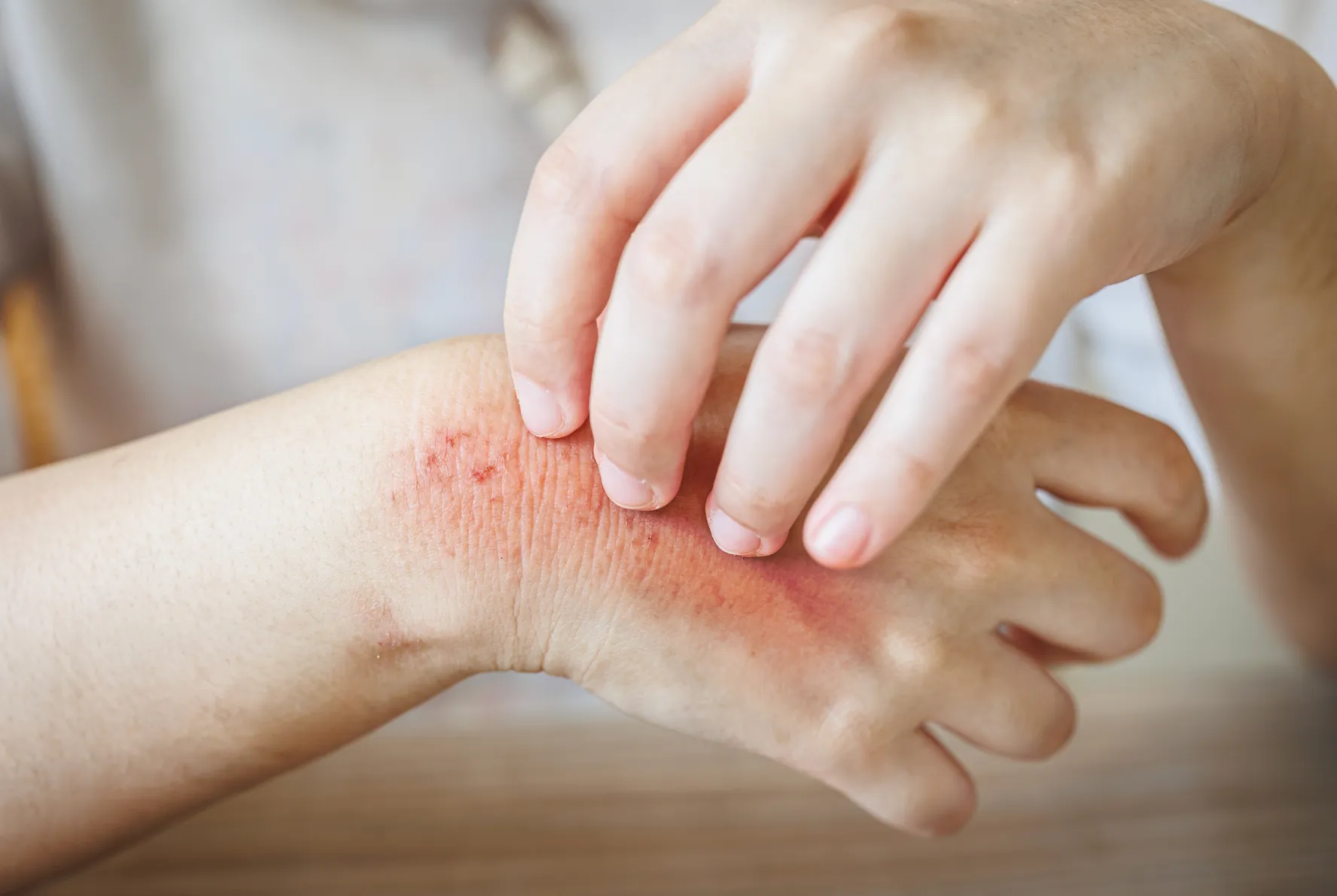 Adverse effects can occur from taking any supplement but these increase the risk of a skin rash if excessively taken.